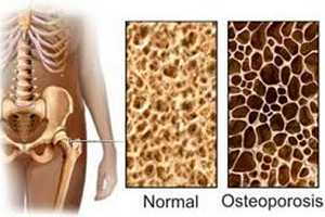 Cómo combatir la Osteoporosis desde la alimentación